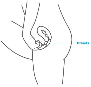 Diagram showing how to perform a monthly Paragard IUD string check: reach up to feel the two thin threads extending from the cervix to confirm the copper IUD is still properly in place